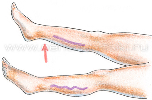 Диагностика варикоза
