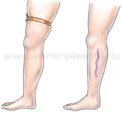 Диагностика варикоза