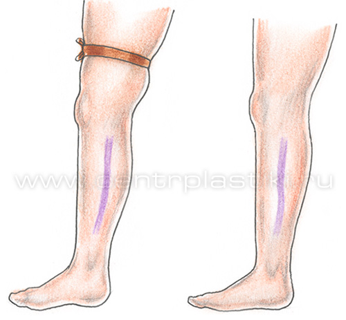 Диагностика варикоза