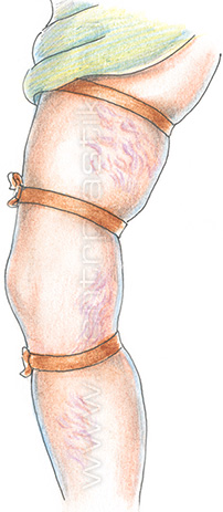 Диагностика варикоза