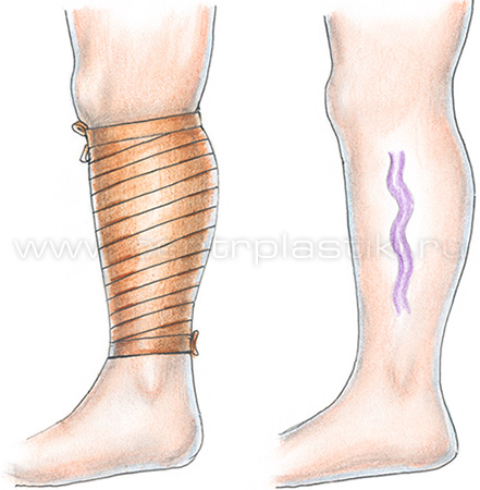Диагностика варикоза
