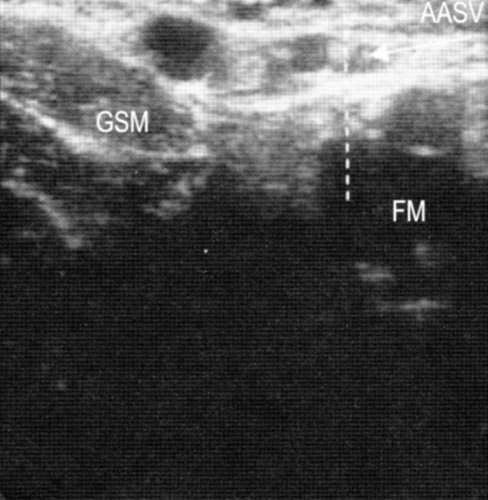 Диагностика варикоза