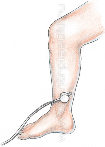 Диагностика варикоза