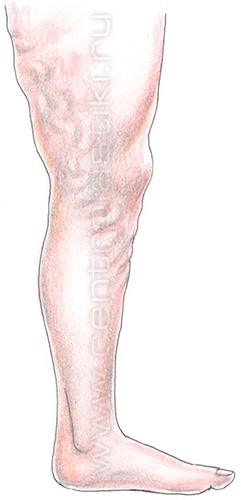 Диагностика варикоза