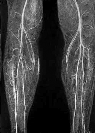 Диагностика варикоза