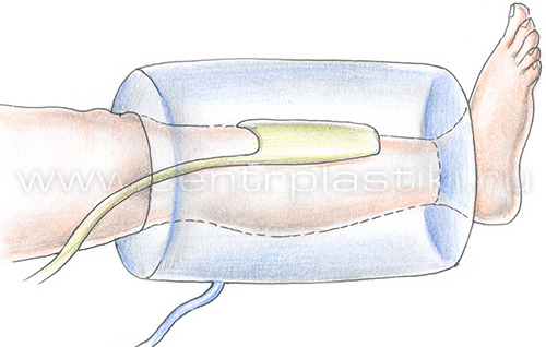 Лечение варикоза