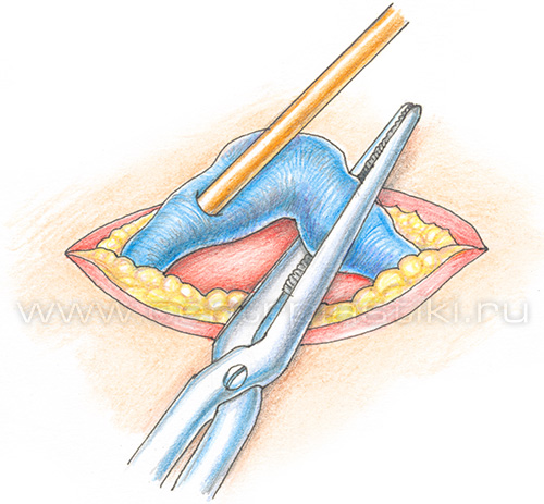 Лечение варикоза лазером
