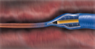 Радиочастотная абляция