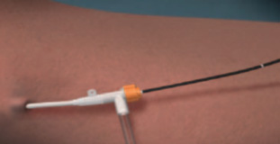 Радиочастотная абляция