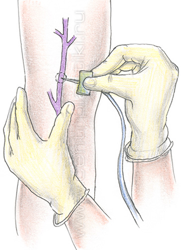 Склеротерапия