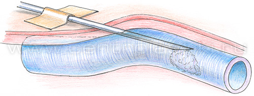 Склеротерапия