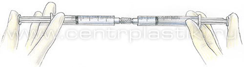 Склеротерапия