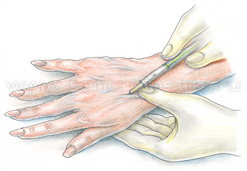 Склеротерапия