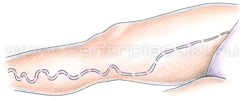 Флебэктомия