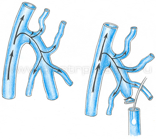 Флебэктомия