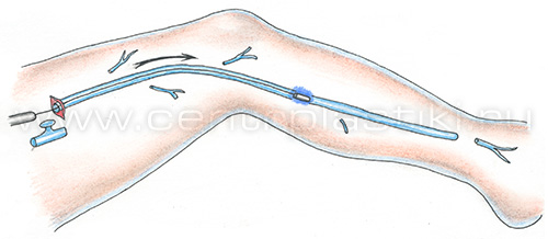 Флебэктомия