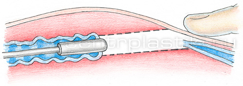 Флебэктомия