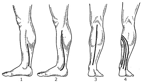 Флебэктомия