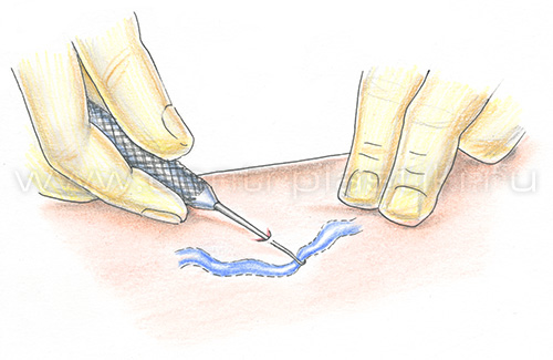 Минифлебэктомия