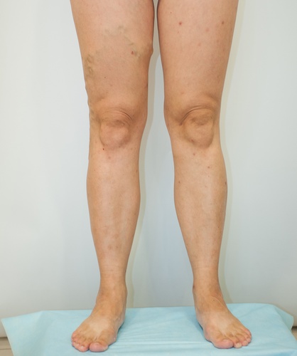 Флебэктомия