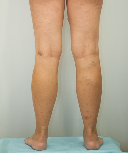 Флебэктомия