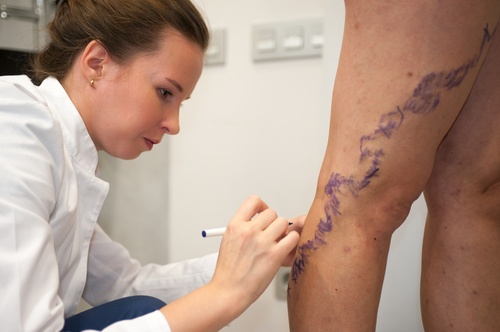 Флебэктомия