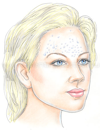 Гипергидроз (потливость)