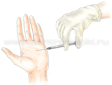 Лечение гипергидроза (потливости) ладоней