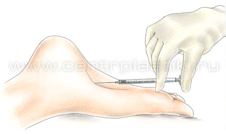 Лечение гипергидроза (потливости) стоп