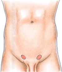 Паховая грыжа