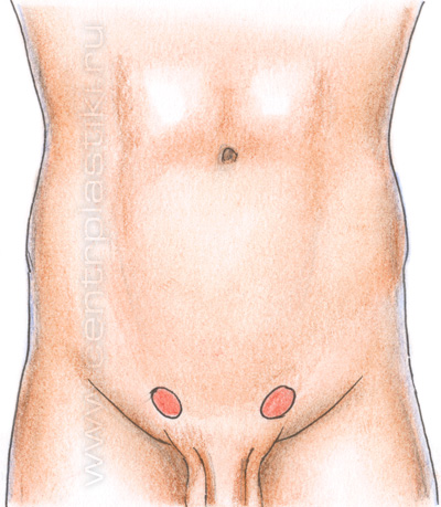 Паховая грыжа