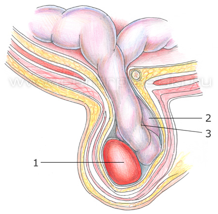 Врожденная паховая грыжа