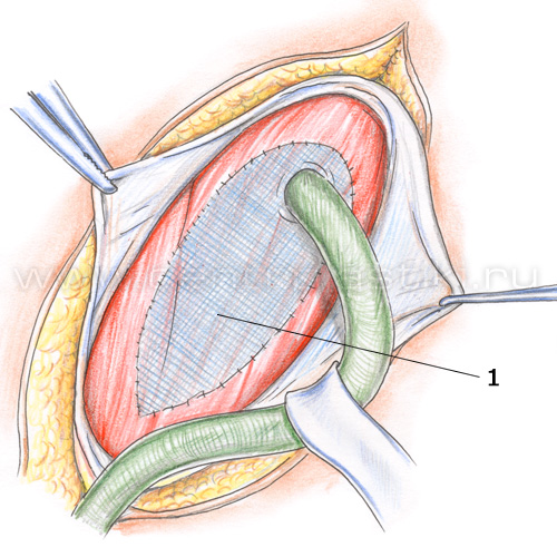 Операция Лихтенштейна