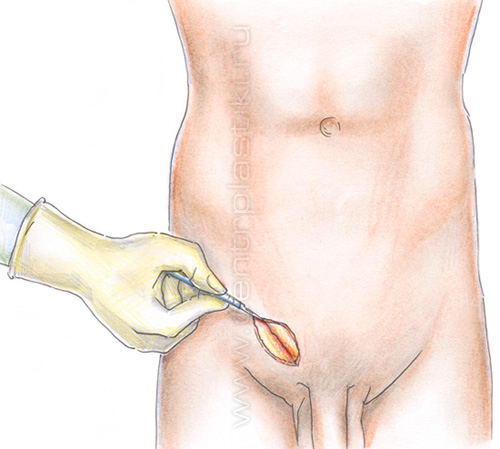 Паховая грыжа