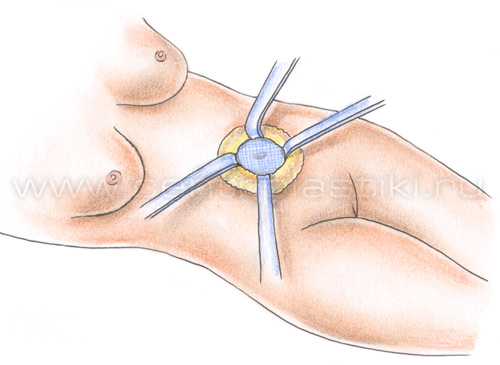 Пупочная грыжа