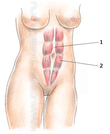 Грыжа белой линии живота