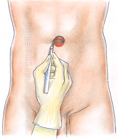 Грыжа белой линии живота