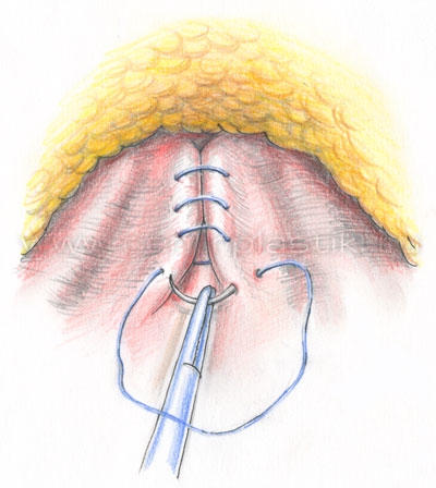 Грыжа белой линии живота