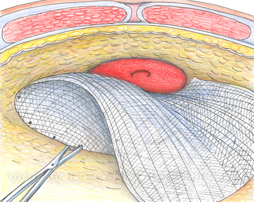 Диафрагмальная грыжа