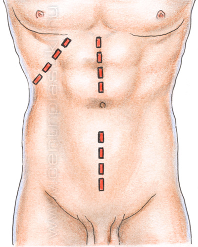 Послеоперационная вентральная грыжа