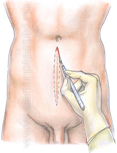 Послеоперационная вентральная грыжа