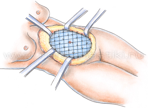 Послеоперационная вентральная грыжа