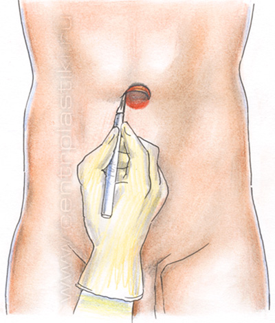 Операция по устранению пупочной грыжи