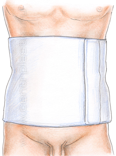 Грыжевой бандаж после операции по удалению грыжи