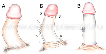 Выпрямление искривления полового члена
