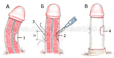 Увеличение полового члена