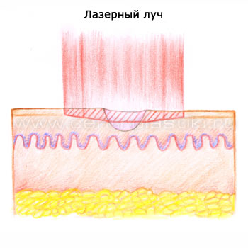 Лазерная шлифовка растяжек