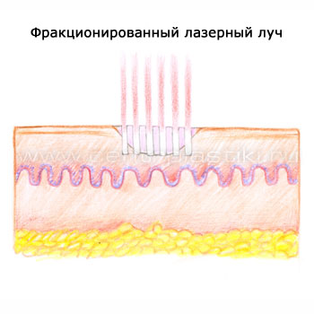 Лечение растяжек лазером
