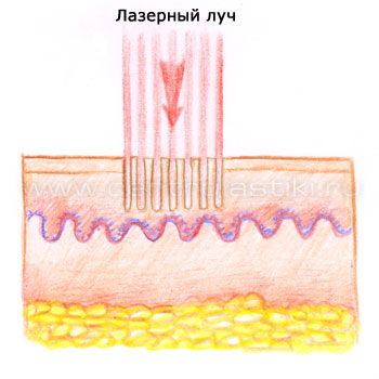 Холодный лазерный пилинг