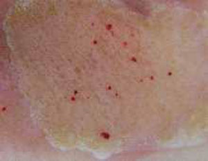 Воздействие лазера на морщины